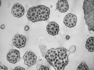 M,12y. | immotile cilia syndrome - nasal mucosa M,12y. | immotile cilia syndrome - nasal mucosa